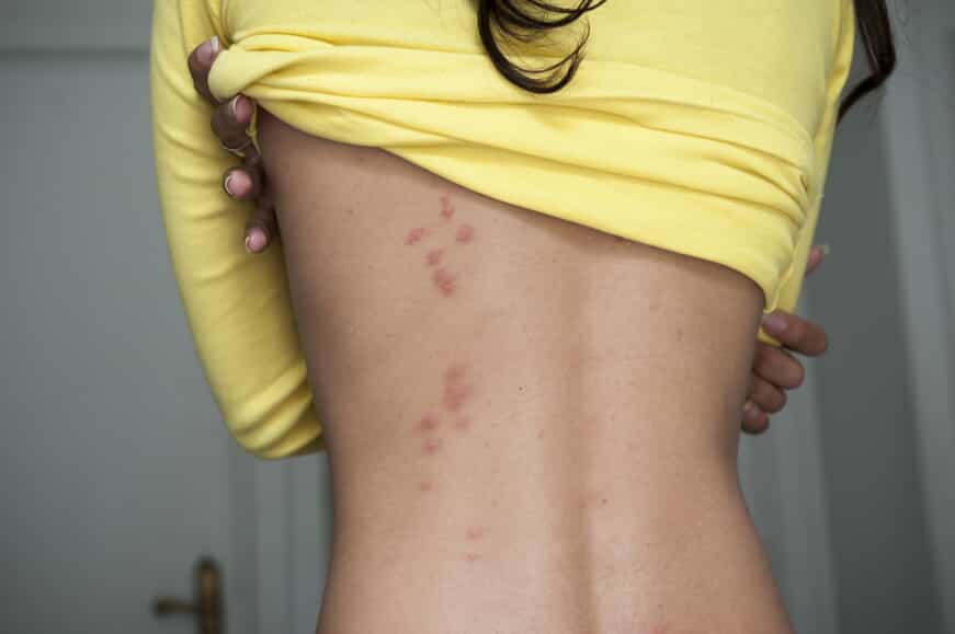 Woman with red welts on her back.